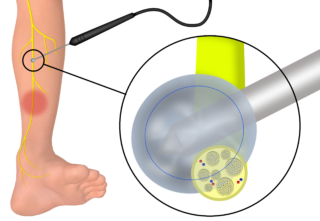 Cryoneurolysis