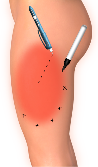 Pinprick neuropathy