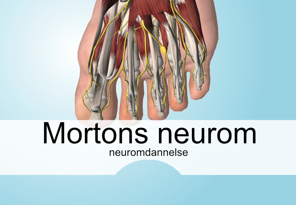 Mortons neurom