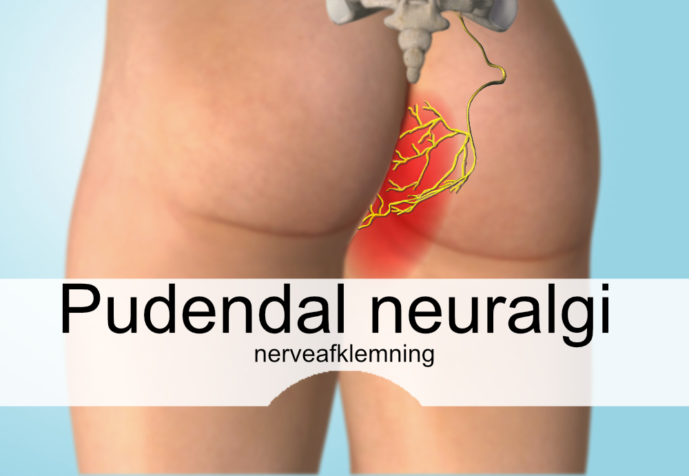 Pudendal neuralgi