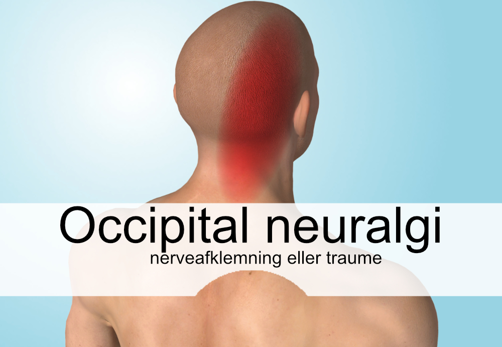 Occipital neuralgi